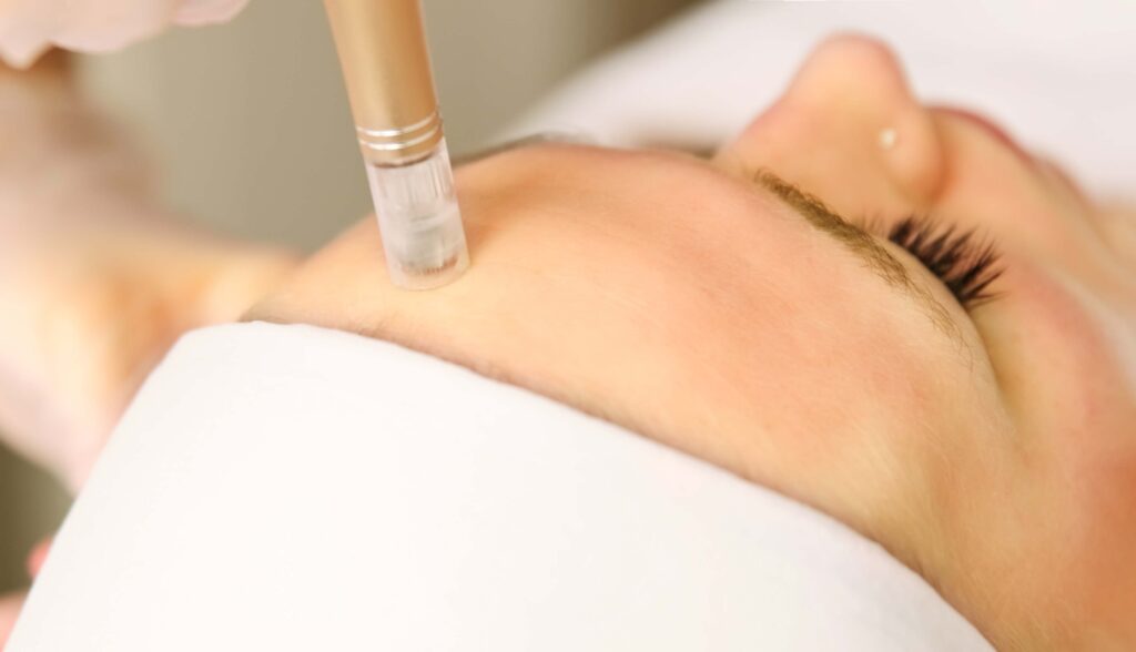 microneedling-jesica-ruiz